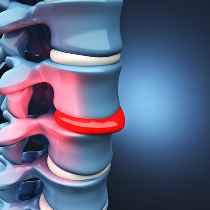 herniated disk